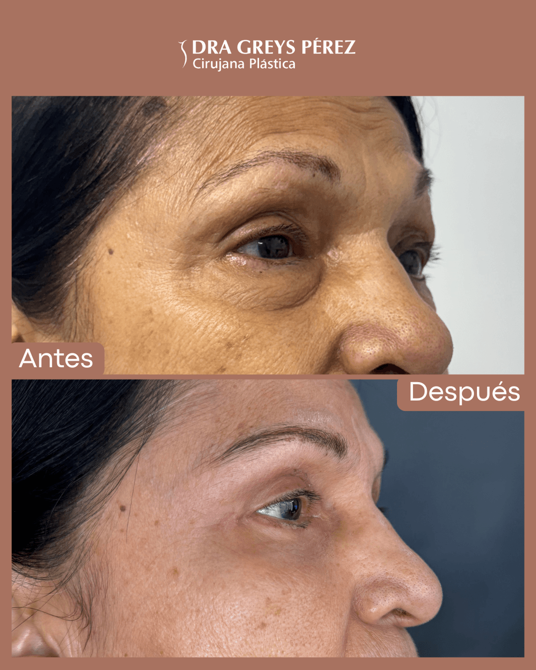 Blefaroplastia